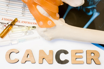 Bone cancer concept. Anatomical shape of femur bone and joint lies near word cancer surrounded by...
