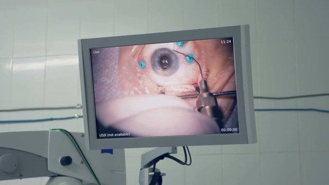 A feed of an eye surgery shown on a large screen. 