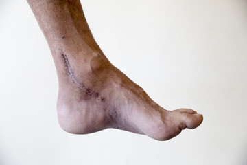 Surgery for the rupture of the Achilles tendon, treatment of inflammation injuries of the tendon.