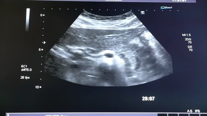 An astonishing X-ray view of a a pregnant woman stomack with a small baby in it. The kid moves actively and his head and arms are seen. 