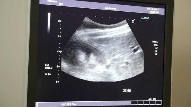 An amazing X-ray view of a a pregnant female stomack with a small baby in it. The baby moves actively and his head and arms are seen. 