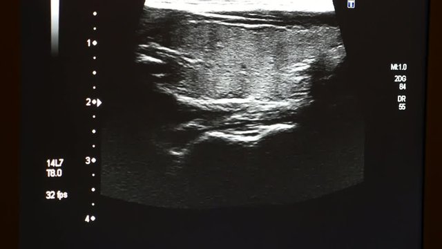 An astonishing X-ray view of a a pregnant woman belly with an active baby in it. The baby moves energetically and his head and hands are seen. 