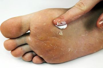 Fungus of foot close-up, isolated on white background. The concept dermatology, treatment fungal...