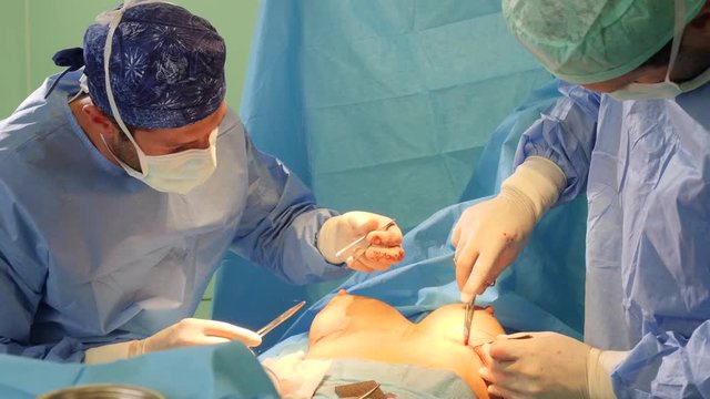 Real surgery team in the operating room. Live session of breast augmentation surgery. 4K slow motion video.