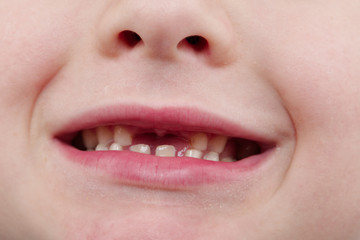 Happy handsome boy showing his changing teeth