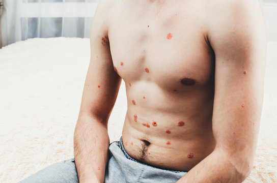 psoriasis, more pronounced on the belly