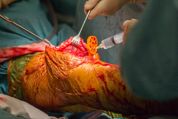 Greffe d'un genou au bloc opératoire