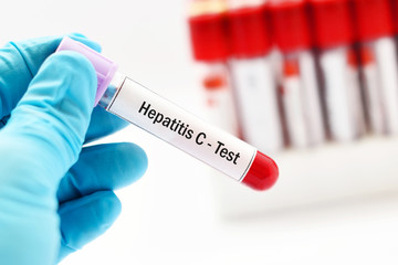 Obraz premium Test tube with blood sample for hepatitis C virus (HCV) test