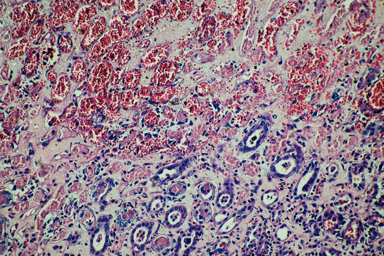 human kidney tissue infarction