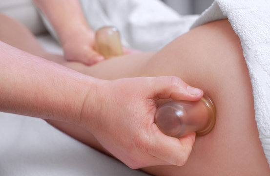 The masseur makes massage with jars of cellulite on the buttock and thighs of the patient. Treatment of excess weight.