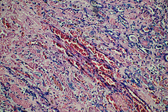 human kidney tissue infarction