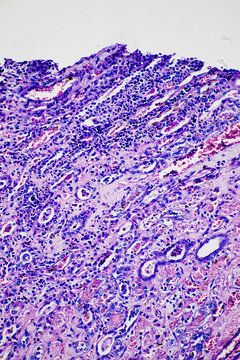 human kidney tissue infarction