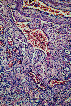 human kidney tissue infarction