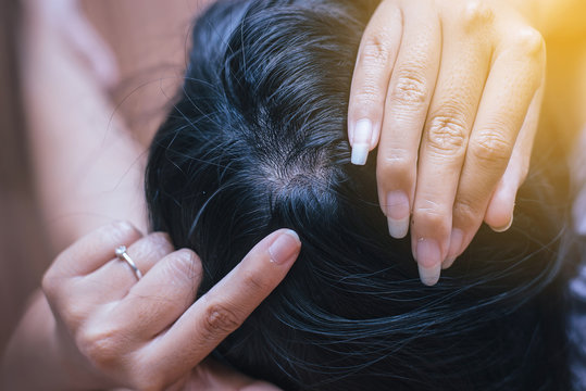 Woman Shows Her Dandruff On Hair Roots,Selective Focus