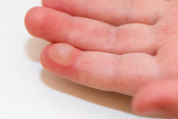 blister on a child's finger