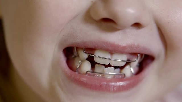 mouth of child with dental braces on teeth for correcting the bite, preschooler is smiling
