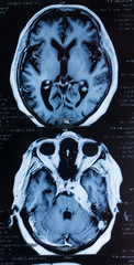 Head MRT. MR image of human brain