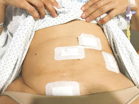 LAPAROSCOPIA INTERVENCION QUIRURJICA EXTIRPACION OVARIO