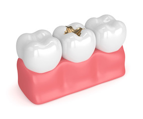 3d render of teeth with dental gold filling