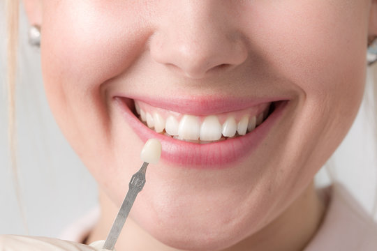Eine Zahnfarbprobe wird an einen Mund einer jungen Frau gehalten