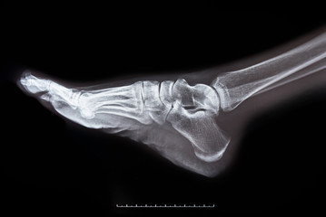 x-ray of foot on black background