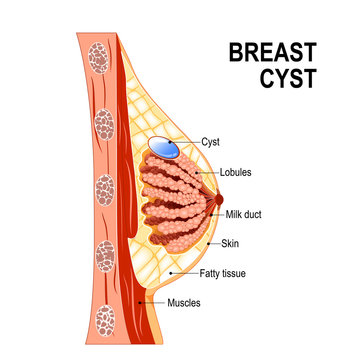 Breast cyst. Women's Health.