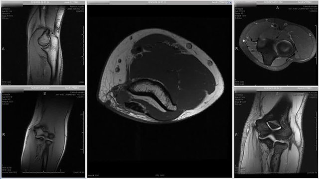 Grid of MRI elbow forearm images with looping central panel view of bicep muscle, white on black background