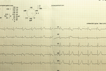 EKG Kurven auf Papier ausgedruckt . Electrocardiogram