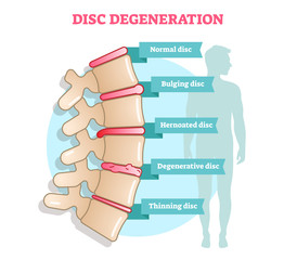 Disc degeneration flat illustration vector diagram with condition exampes - bulging, hernoated, degenerative and thinning disc. Educational medical information.
 - obrazy, fototapety, plakaty