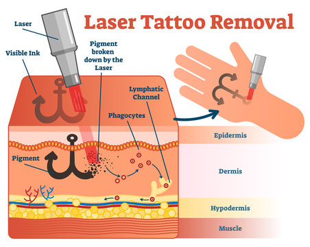 Laser tattoo removal vector illustration diagram. Cosmetic dermatology visual information. 
