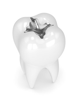 3d render of tooth with dental amalgam filling