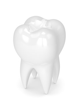 3d render of tooth with dental composite filling