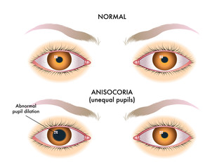 symptoms of unequal pupils called anisocoria