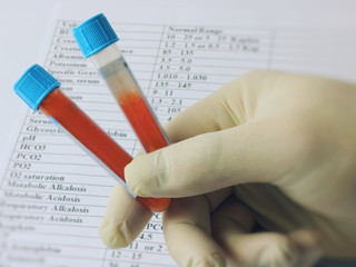 Hematology blood analysis report. Test tubes with blood, a lab technician in gloves holds in his hand
