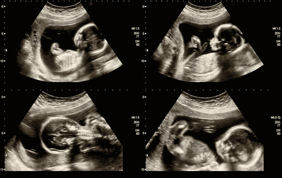 Medical images collage of ultrasound during woman pregnancy showing fetus in third month