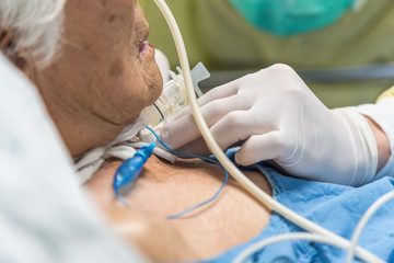 Patient do tracheostomy and ventilator in hospital