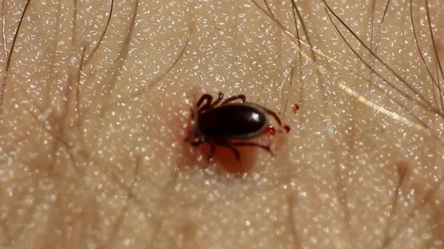 Tick Fastened to Human Skin Feeding on Blood