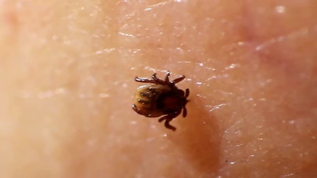 Tick Fastened to Human Skin Feeding on Blood