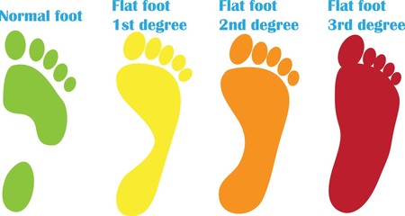 orthopedic steps of flst foot