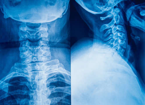 X-Ray Image of human neck for a medical diagnosis.