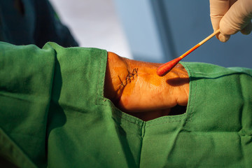 Hand incise wound