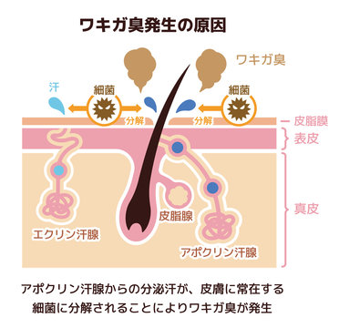 ワキガ臭発生の原因イラスト (腋臭・わきが）
