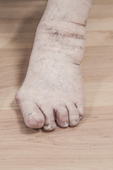 closeup of a senior person's left foot with arthritis, damaged nails