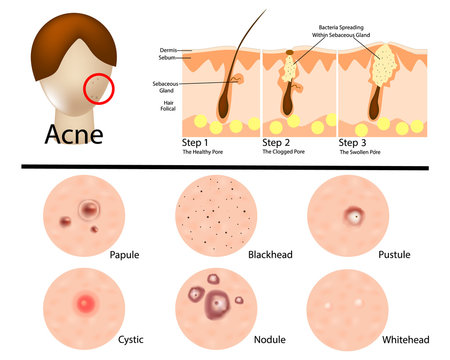 Different types of acne illustration/ Acne stages. Infographic