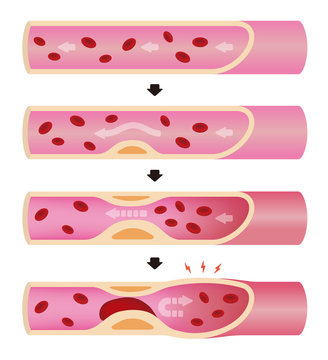 Progression of arteriosclerosis illustration (No text)