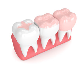 3d render of teeth with different types of filling