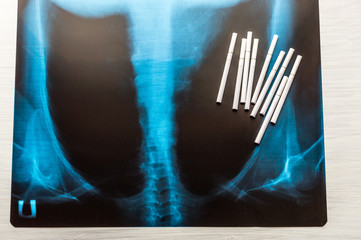 X-ray of the lungs. concept fight with smoking