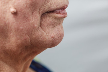 Elderly pensioner female, dermal fibroma closeup.