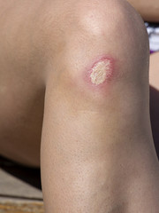 Wound on the foot of a woman , close up