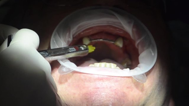 dentista effettua operazione di implantologia su di un paziente